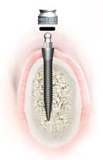 Mini Dental Implants Slayton, MN