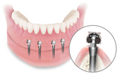 Mini Dental Implants Slayton, MN