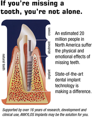 Dental Implants